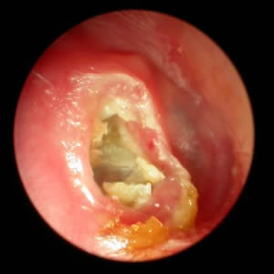 Cholesteatoma Surgery