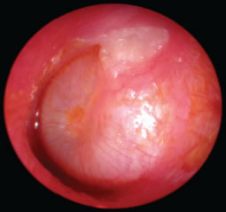 How is cholesteatoma diagnosed?