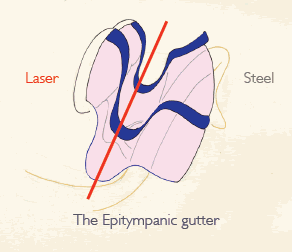 The Epitympanic Gutter