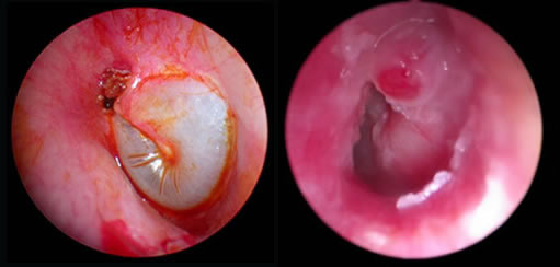 What is cholesteatoma?