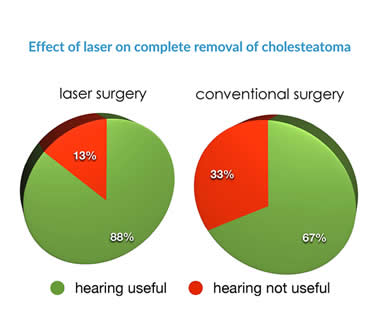 Effect of laser on rate of complete removal of cholesteatoma
