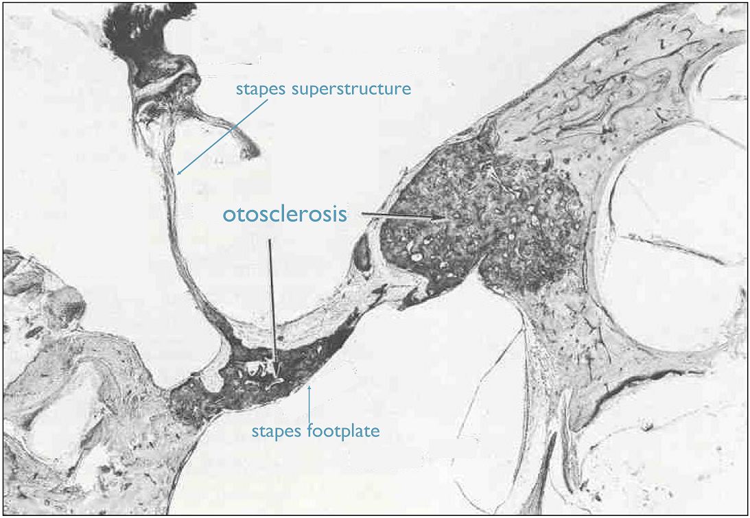 Otosclerosis