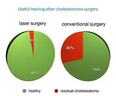Effect of laser on usefulness of hearing after cholesteatoma surgery